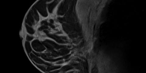 Breast MRI: A Radiologist’s Newest Tool in the Detection of Breast Cancer